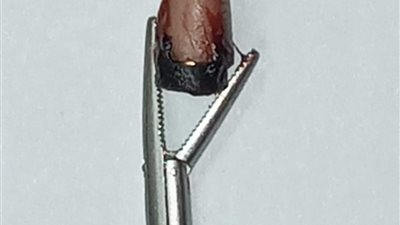 اتحشرت في ودنه.. استخراج سماعة غش من أذن طالب ثانوية عامة بقنا