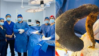 طولها 40 سم.. أطباء يستخرجون كتلة شعر من معدة امرأة في إسبانيا