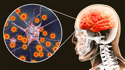 ارتفاع معدل الإصابات بمرض التهاب السحايا في بريطانيا 