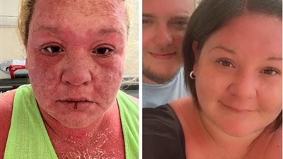 بريطانية تصاب بحالة مرضية خطيرة بعد تعرضها للدغة بعوض النمر