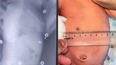 ولادة رضيعة روسية برصاصة في بطنها بعد ما أطلق والدها النار على والدتها خلال الحمل