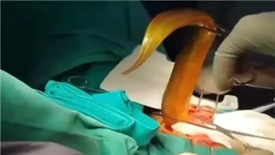 ثعبان بحر حي طوله 25 بوصة يدخل إلى معدة شاب هندي.. ما القصة؟