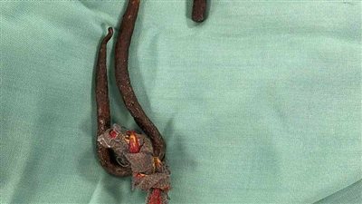 أنقذوها من الموت المحقق.. المستشفى الجامعي بأسوان يستخرج سيخا حديديا من حلق طفلة