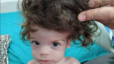  للمرة الأولى بجامعة الإسكندرية.. عملية نادرة لفصل توأم ملتصق عن طريق الرأس