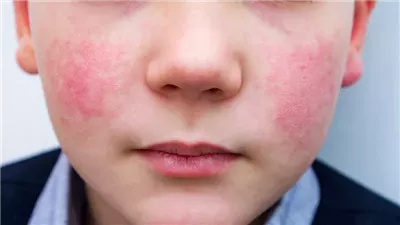 مراكز السيطرة على الأمراض الأمريكية تحذر من ارتفاع حالات الإصابة بفيروس بارفو