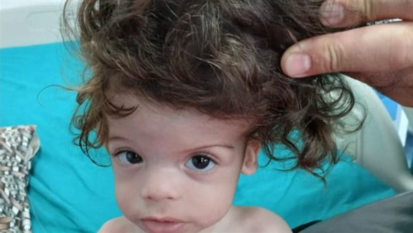 التوأم الملتصق 