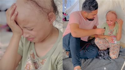 خوفا من القصف.. صغيرة فلسطينية تفقد شعرها من شدة الهلع: نفسي أسرح زي البنات
