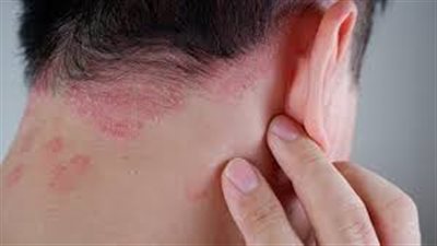 هل الرجال أكثر عرضة للإصابة بالصدفية؟