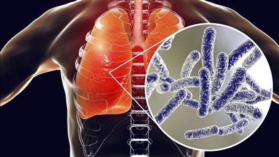 إيطاليا تسجل 4 وفيات بعد تفشي مرض الفيالقة في ميلانو 