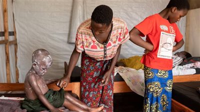 7 ملايين نازح.. وكالات أممية تحذر من تفشي فيروس جدري القرود في مخيمات اللاجئين بالكونغو