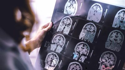 دراسة: مرض السكري يسبب شيخوخة الدماغ ويغير نمط الحياة 