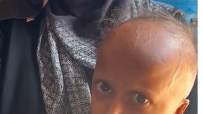 سوء تغذية وجفاف وتساقط الشعر.. لقطات من معاناة أطفال غزة 