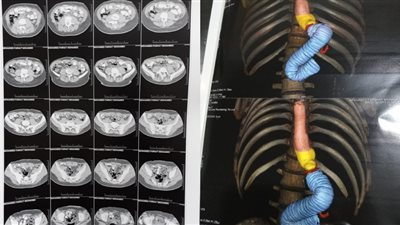 والدة شاب تعرض لإهمال طبي في مستشفى الكبد بالدقهلية: الدكتور قالي هيموت ومحتاج عملية بـ200 ألف