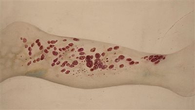  خبراء: أدوية علاج ارتجاع المريء تؤدي إلى الإصابة بمرض الإسقربوط