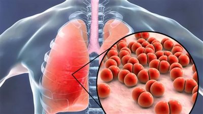 تحذيرات صحية بعد تصاعد معدلات الإصابة بمرض السل في إنجلترا 