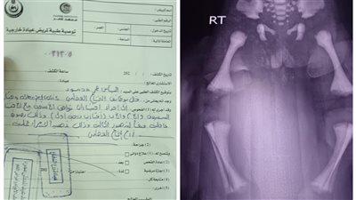 والد رضيع بالقليوبية يستغيث لعلاجه: يعاني من مرض وراثي نادر ويحتاج لزراعة نخاع بـ600 ألف جنيه