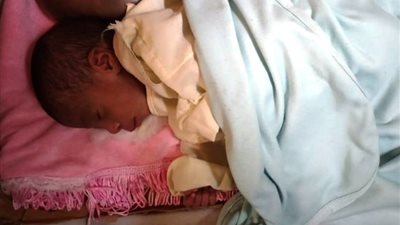 الطفلة رحمة تعاني من تشوه برأسها.. وأسرتها فشلت في علاجها لظروفها المادية