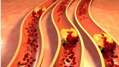 دراسة جديدة تكشف تأثير ارتفاع الكوليسترول وطرق خفضه