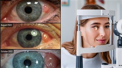 يموت بسببه 130 شخصا سنويا.. استئصال عين سيدة سويدية مصابة بسرطان نادر