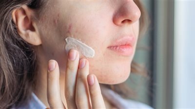 كيفية إزالة آثار الحبوب من الوجه.. استشر طبيبك أولا 