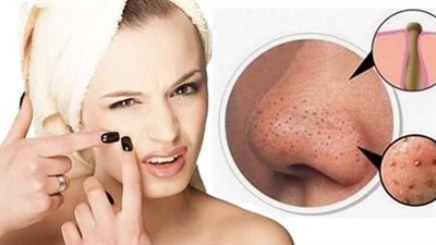 وصفة لإزالة الحبوب من الوجه في يوم واحد.. 7 وصفات أبرزها الماء المالح