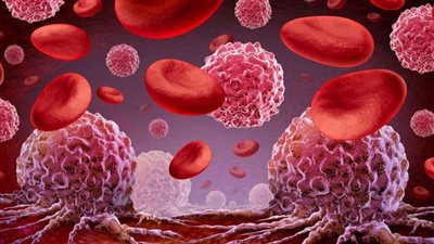 معلومات عن سرطان الدم وطرق العلاج