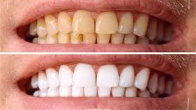 عميد طب أسنان الأزهر تحذر من تبييض الأسنان دون إشراف طبي 