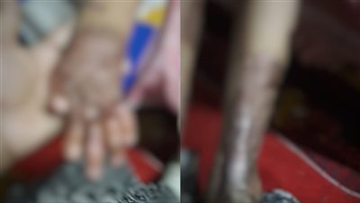 فقدت أذنها في الحادث.. سيدة تستغيث لمساعدة صغيرة خسرت عائلتها في انفجار أنبوبة