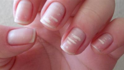 أبرزها هشاشة الأظافر.. أهم العلامات على الإصابة بـ نقص التغذية