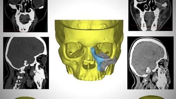 أطباء الأقصر ينجحون