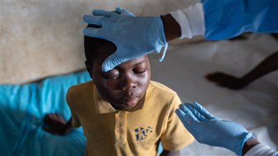 مخاوف من سلالة جديدة شديدة العدوى من جدري القرود 