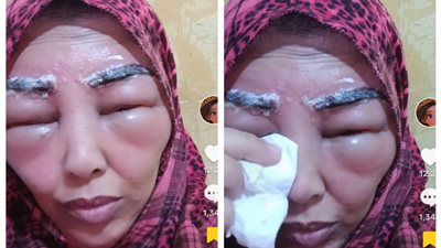 كأني مضروبة.. سيدة تستغيث بعد إجرائها تاتو حواجب بمركز تجميل: قلت للكوافيرة عندي حساسية