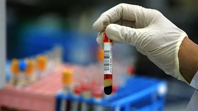 باحثون يعلنون التوصل إلى اختبار جديد للكشف عن السكري وأمراض القلب قبل الإصابة 