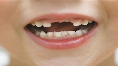 أطعمة شائعة تضر بصحة الأسنان.. تعرف عليها 