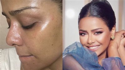 أسماء أبو اليزيد تكشف حالتها الصحية بعد إصابتها بالتهابات في الوجه