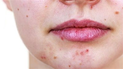 دراسة: كريمات حب الشباب الشائعة تكون مسرطنة في درجة حرارة الغرفة