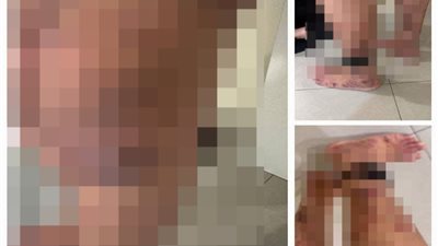 قوات الاحتلال تستخدم الجرب كأداة لتعذيب الأسرى الفلسطينيين