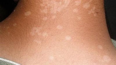 هل البقع البيضاء بالبشرة مؤشر لنقص التغذية؟ 