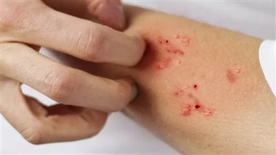 بعد تفشيه في بريطانيا.. تعرف على أعراض الإصابة بمرض الجرب الجلدي