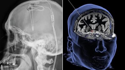 باحثون يكتشفون طريقة فعالة لعلاج الإدمان عن طريق الموجات فوق الصوتية | دراسة