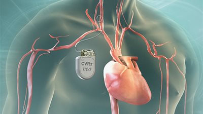 لأول مرة بمدن القناة.. تركيب أول جهاز منظم للقلب بالتقنية الحديثة ببورسعيد 
