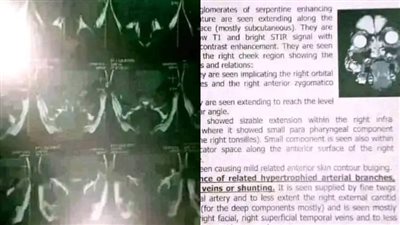 أم تستغيث لعلاج ابنتها المصابة بورم دموي: مبقتش بتشوف ومش معايا تكاليف علاجها