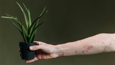 دراسة: خطر الإصابة بالإكزيما يزداد بسبب الهواء الملوث