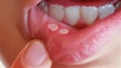 5 علاجات منزلية طبيعية لقرحة الفم.. تعرف عليها