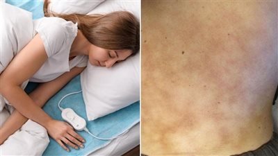 تسبب طفحا جلديا خطيرا.. أطباء يحذرون من استخدام البطانيات خلال فصل الشتاء
