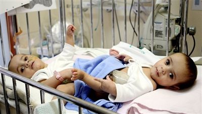 في اليوم العالمي للتوائم الملتصقة.. ما هي أنواع الحالات النادرة؟