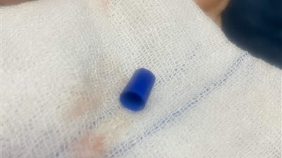 ابتلع جزءًا من قلم جاف.. فريق طبي ينقذ حياة صغير في قنا