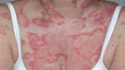 يحتاج فريق طبي كامل لعلاجه.. تعرف على مرض الذئبة الحمراء وأسباب الإصابة به