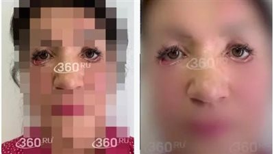 فقدت القدرة على إغلاق عينيها.. روسية تتقدم بدعوى قضائية ضد طبيبة بعد فشل عملية تجميل