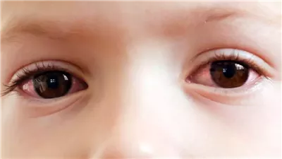 تسبب أعراض خطيرة.. تحذيرات من متلازمة جفاف العين